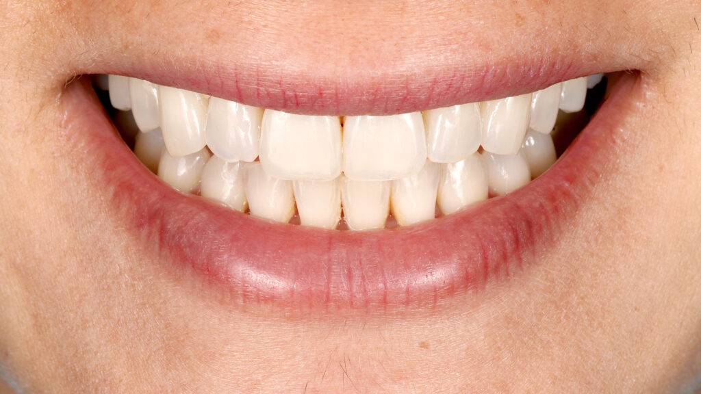 5 preguntas de blanqueamiento dental en procedimientos de rehabilitación